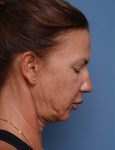 before facelift neck lift right side face down view female patient case 1582