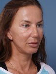 after facelift neck lift right angle view female patient case 1582