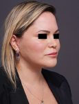 after facelift neck lift right angle view female patient case 1573