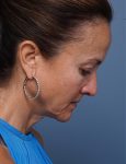 before facelift neck lift right side head down view female patient case 1602
