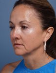 before facelift neck lift left angle view female patient case 1602