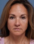 after facelift neck lift front view female patient case 1602
