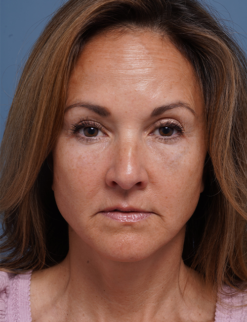 after facelift neck lift front view female patient case 1602
