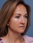after facelift neck lift right angle view female patient case 1602