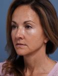 after facelift neck lift left angle view female patient case 1602