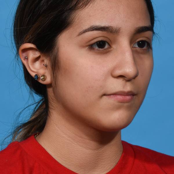 before rhinoplasty right angle view female patient case 1236