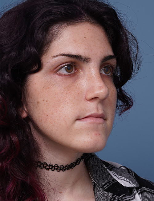 after rhinoplasty right angle view female patient case 1724