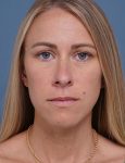 before rhinoplasty front view female patient case 1737