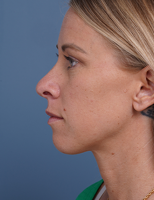 before rhinoplasty left side view female patient case 1737