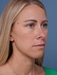 before rhinoplasty right angle view female patient case 1737