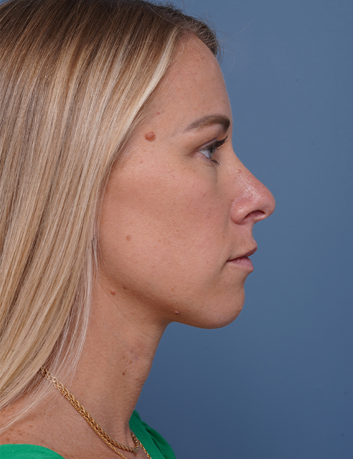 before rhinoplasty right side view female patient case 1737
