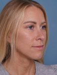 after rhinoplasty right angle view female patient case 1737