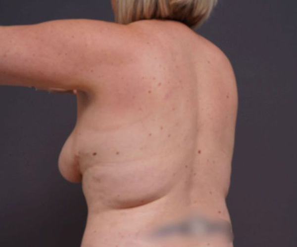 before breast augmentation left angle arms up view female patient case 2048