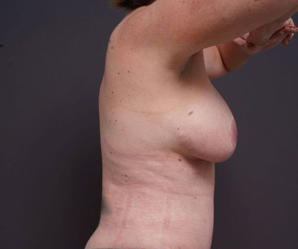 after breast augmentation right side arms up view female patient case 2048