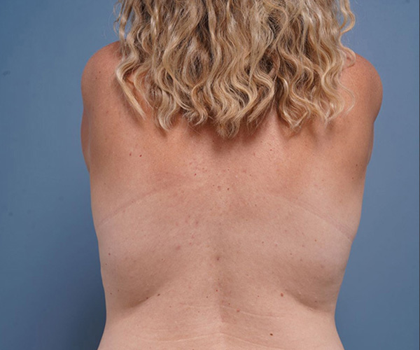 before breast lift back view female patient case 2373