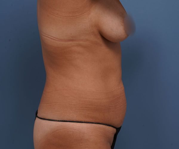 before tummy tuck right side view of female patient 2273