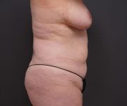before tummy tuck right side view of female patient 2280