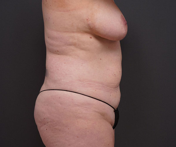before tummy tuck right side view of female patient 2280
