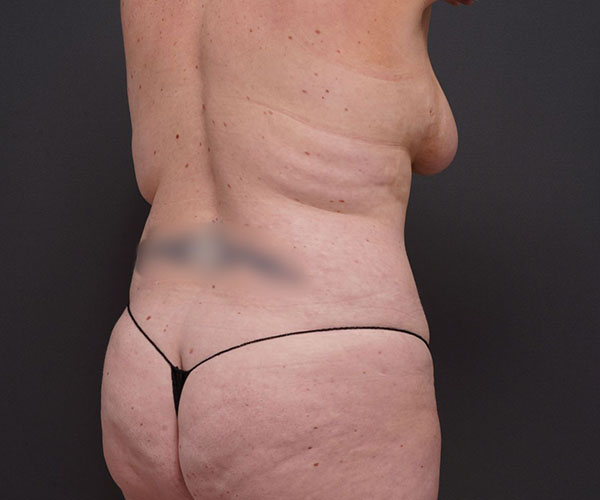 before tummy tuck rear right angle view of female patient 2280