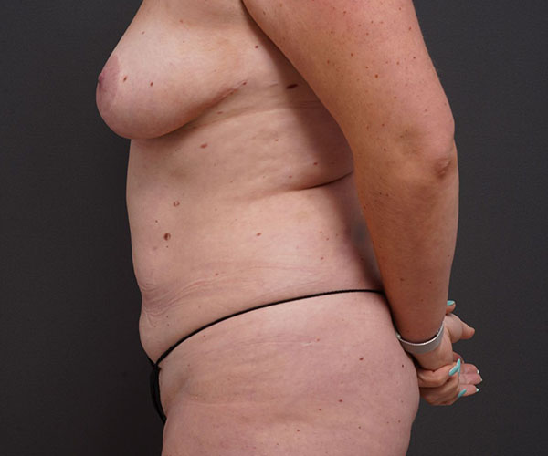 before tummy tuck left side view of female patient 2280
