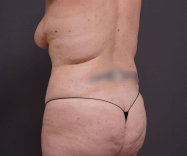 before tummy tuck left angle view of female patient 2280