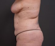 before tummy tuck left side view of female patient no hands 2280