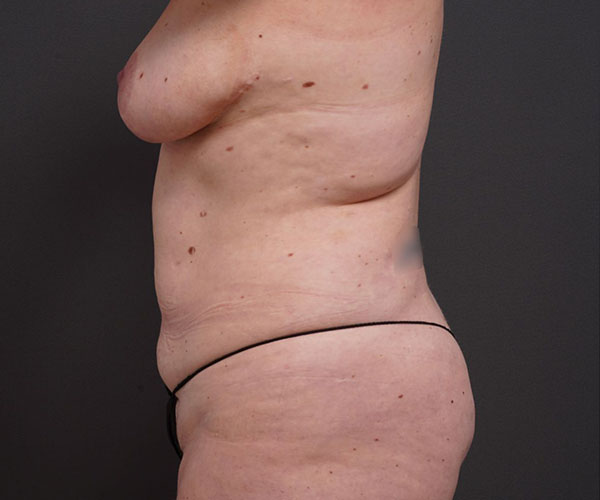 before tummy tuck left side view of female patient no hands 2280