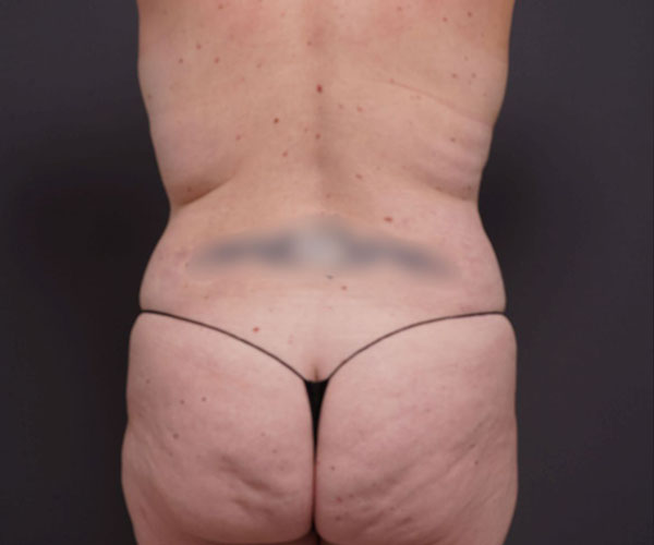 before tummy tuck rear view of female patient 2280