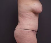 after tummy tuck right side view of female patient no hands 2280