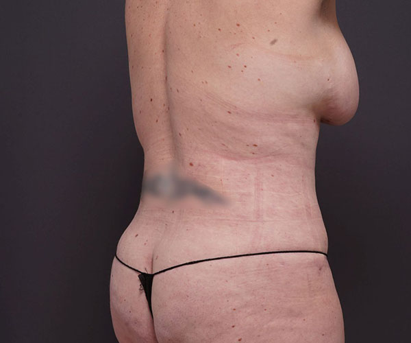 after tummy tuck right angle rear view of female patient 2280