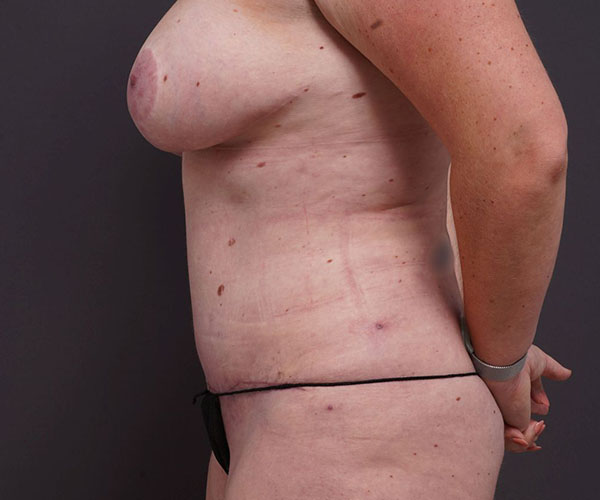 after tummy tuck left side view of female patient 2280