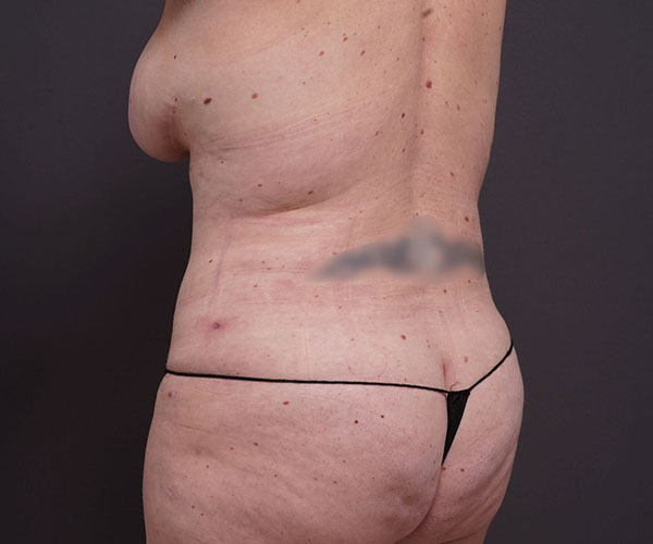 after tummy tuck left angle rear view of female patient 2280