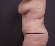 after tummy tuck left side view of female patient 2280