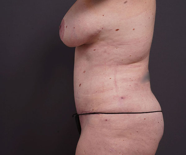 after tummy tuck left side view of female patient 2280