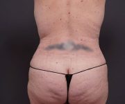 after tummy tuck rear view of female patient 2280