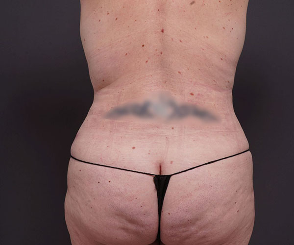 after tummy tuck rear view of female patient 2280