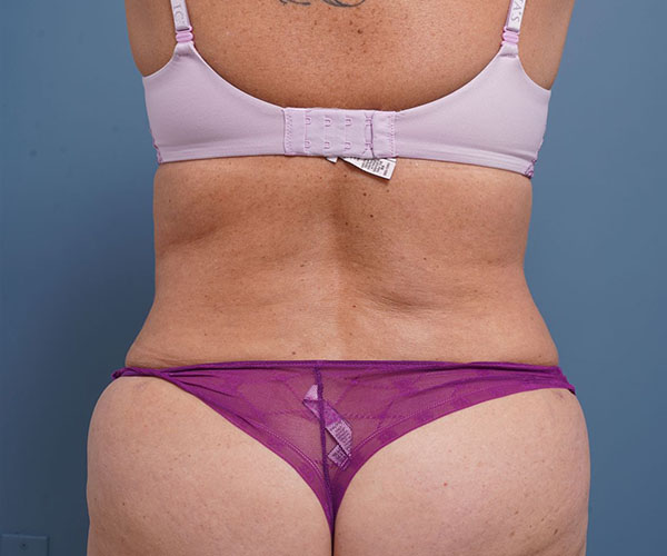 after tummy tuck rear view of female patient 2302