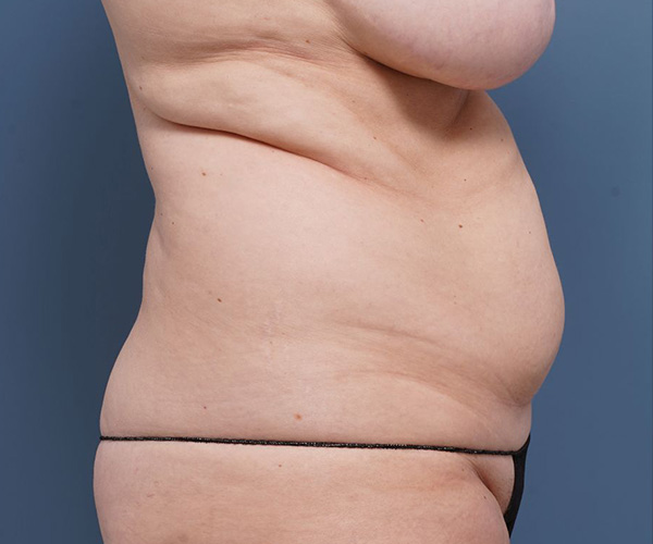 before tummy tuck right side arms up view female patient case 2351