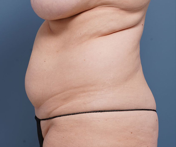 before tummy tuck left side view female patient case 2351