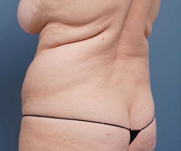 before tummy tuck left angle view female patient case 2351