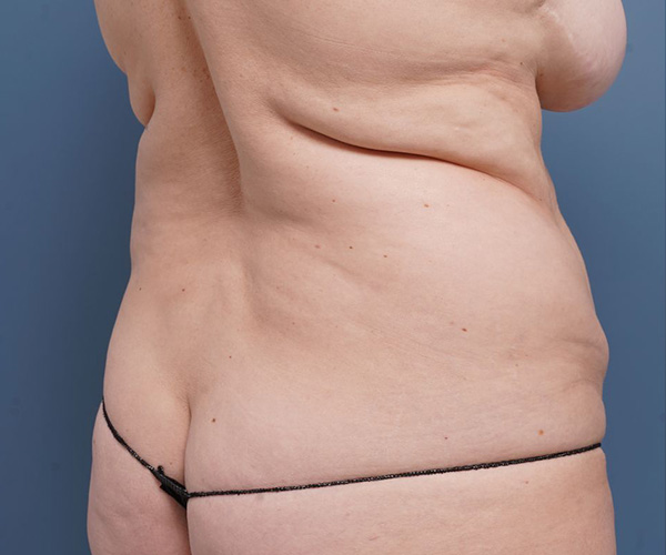 before tummy tuck right angle view female patient case 2351