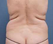 before tummy tuck back view female patient case 2351