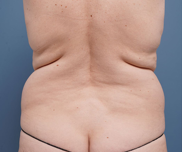 before tummy tuck back view female patient case 2351