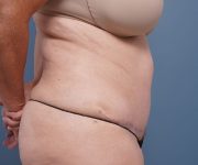 after tummy tuck right side view female patient case 2351