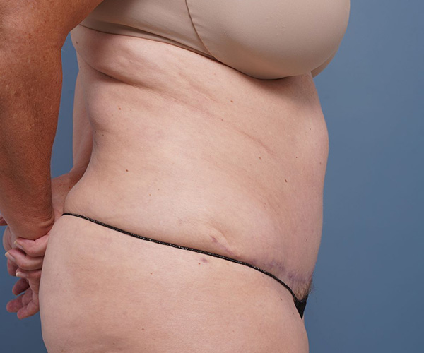 after tummy tuck right side view female patient case 2351