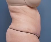 after tummy tuck right side arms up view female patient case 2351
