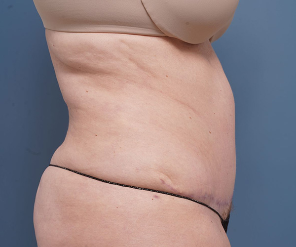 after tummy tuck right side arms up view female patient case 2351