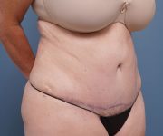 after tummy tuck right angle view female patient case 2351