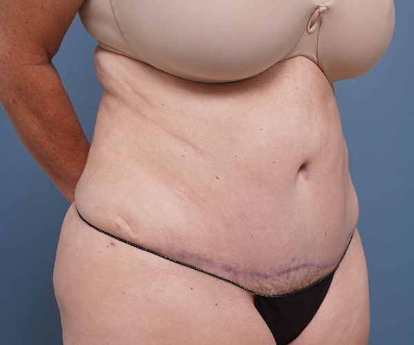 after tummy tuck right angle view female patient case 2351