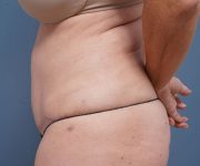 after tummy tuck left side view female patient case 2351